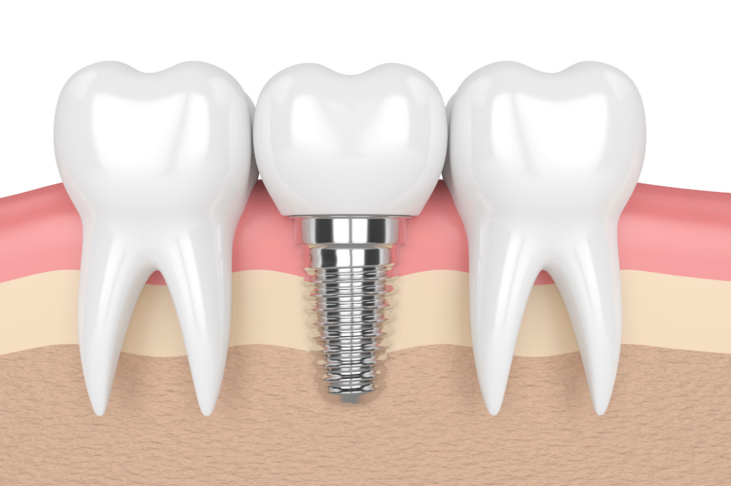 Risks Associated With Dental Implant Surgery