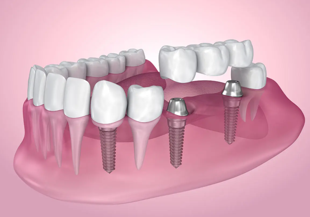 Risks Associated With Dental Implant Surgery