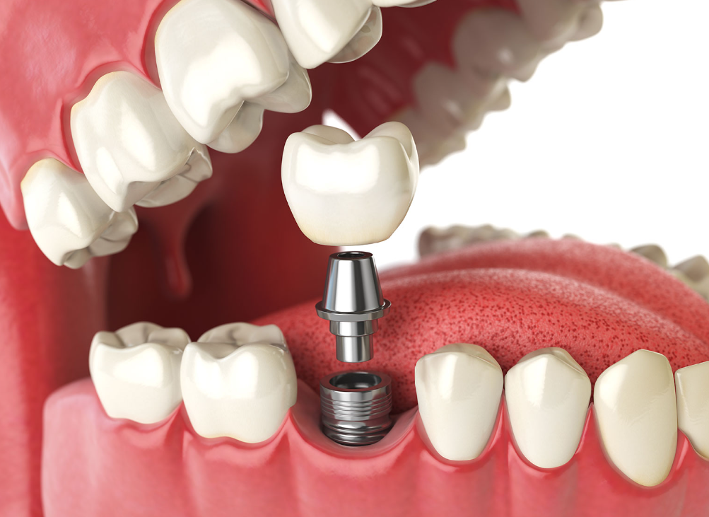 Risks Associated With Dental Implant Surgery